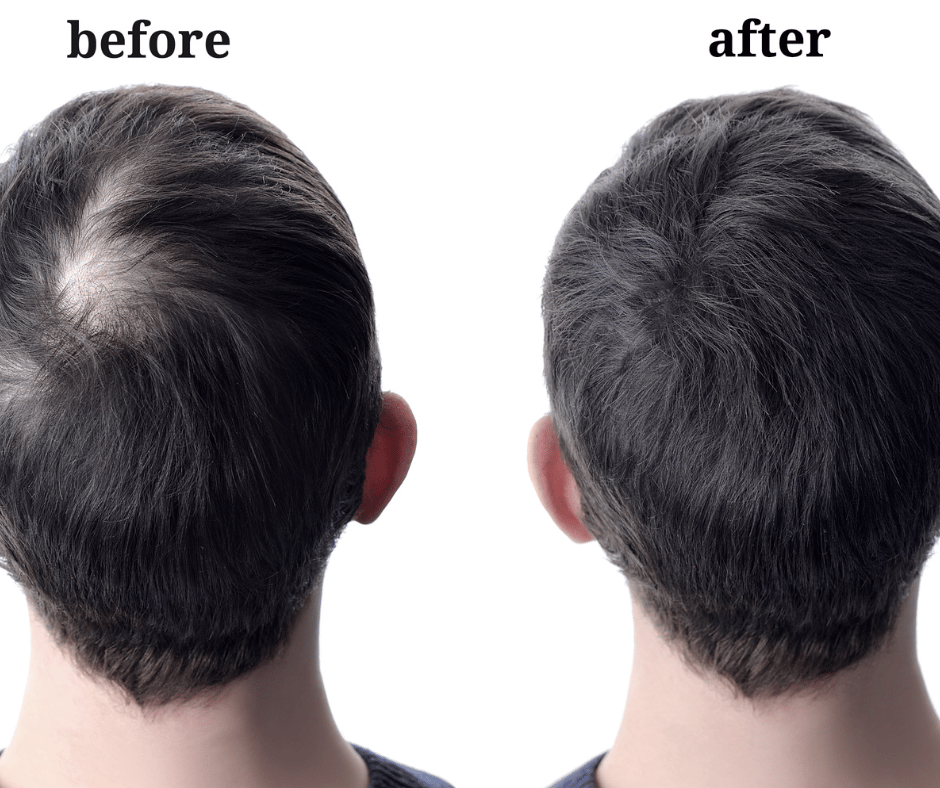 Great iRestore Essential Laser Hair Growth System