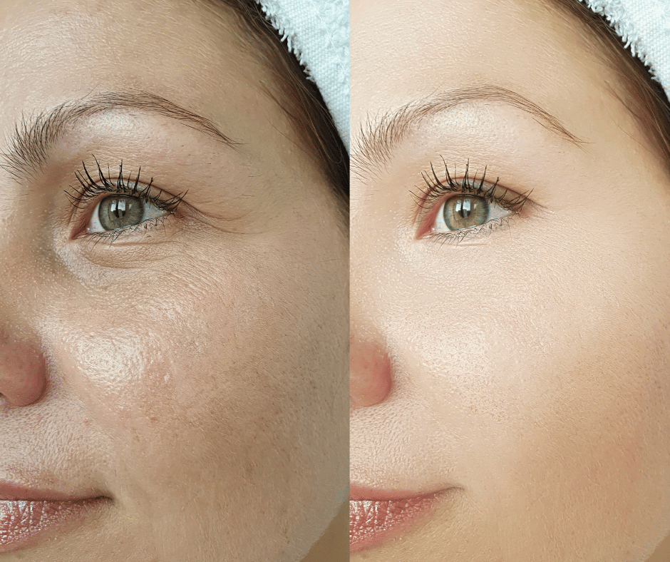 Paulas Choice--SKIN PERFECTING 2% BHA Liquid Salicylic Acid Exfoliant Facial Exfoliant for Blackheads, Enlarged Pores, Wrinkles & Fine Lines Skin tone