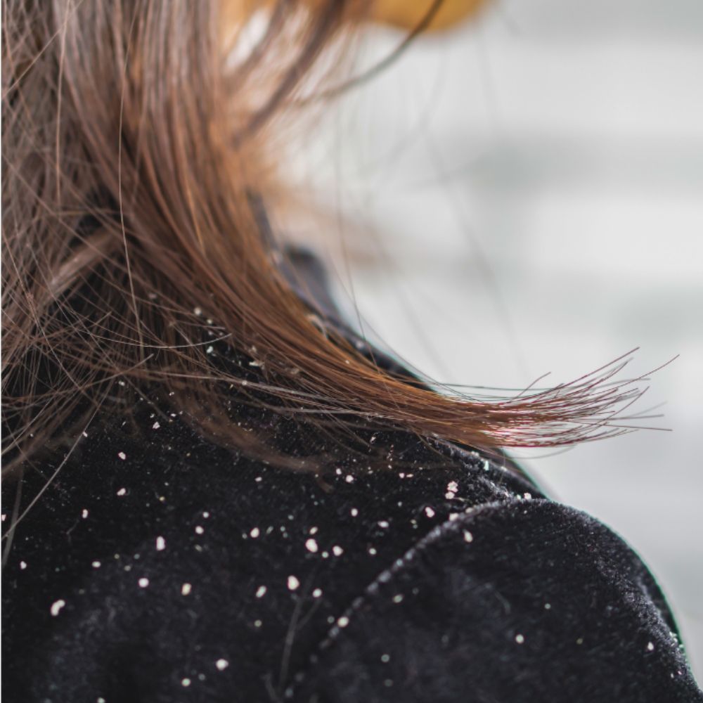 Dry Shampoo Buildup