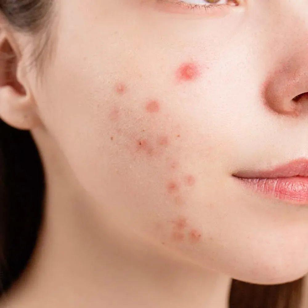 the best primer to hide acne scars