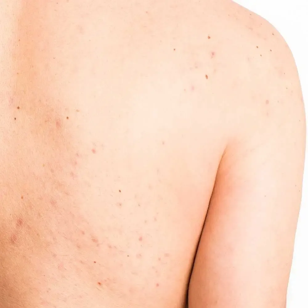 back of a male with acne