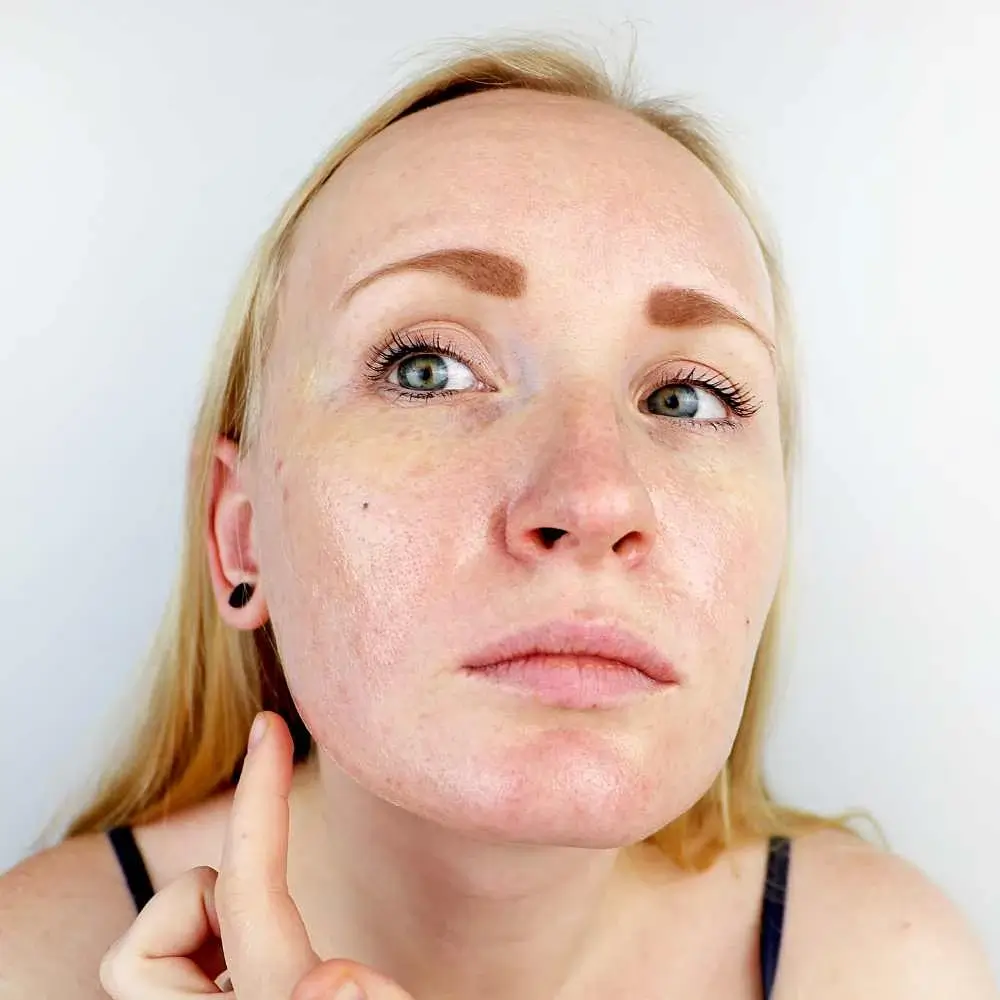 blonde woman with oily skin and pigmentation