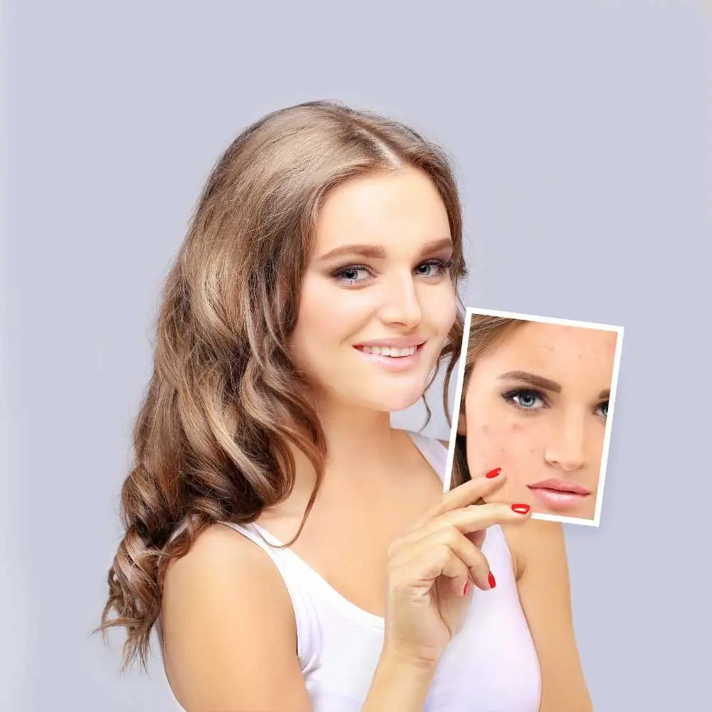 beautiful smiling brunette woman holding her old photo with acne marks
