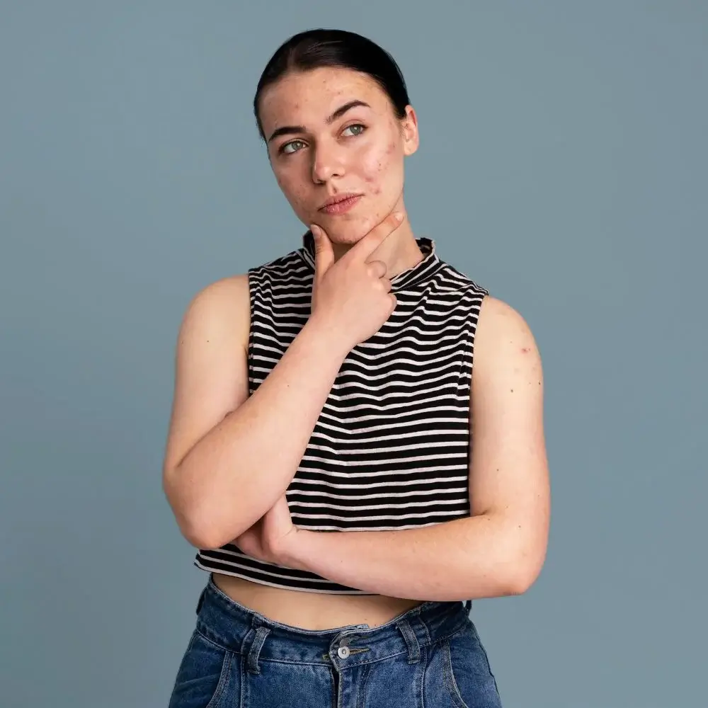 How do you cure Hormonal Acne naturally?