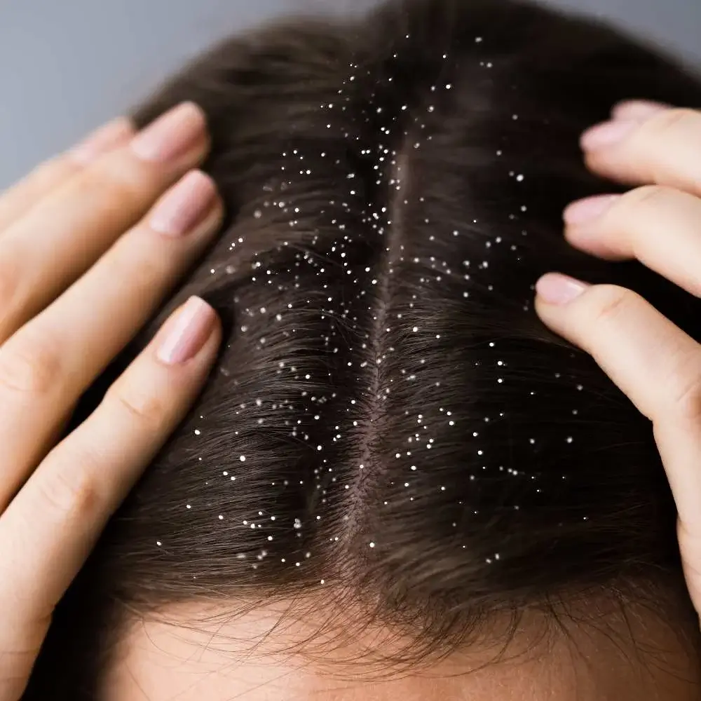 Itchy situation: Dealing with dandruff
