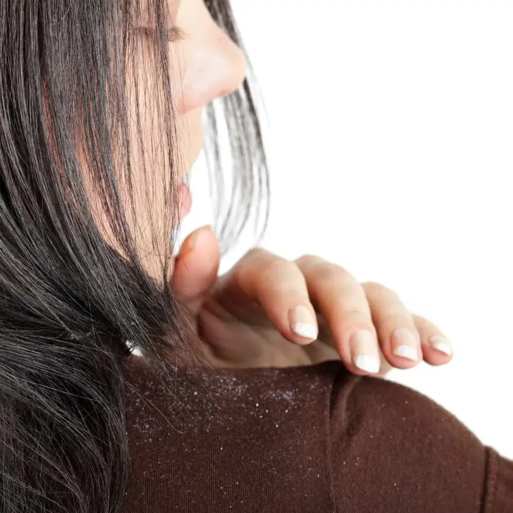 Pesky scalp flakes: The dandruff dilemma