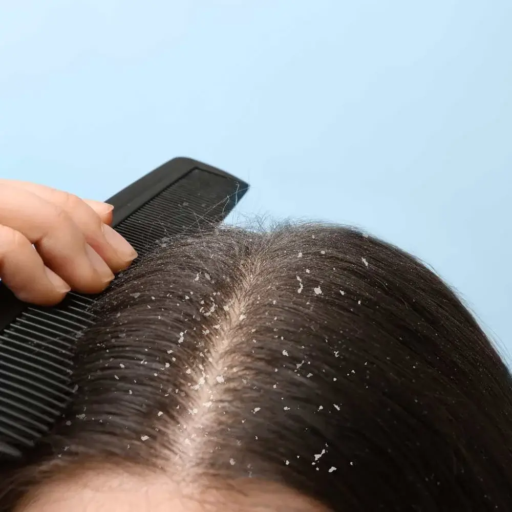 Dandruff drama: Confronting the scalp's nemesis