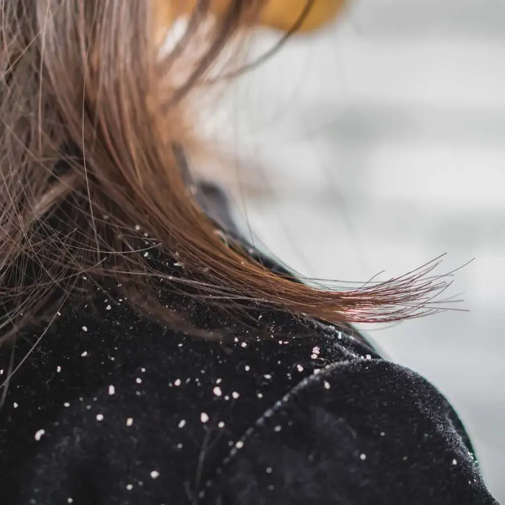 Snowy scalp: The dandruff battle begins