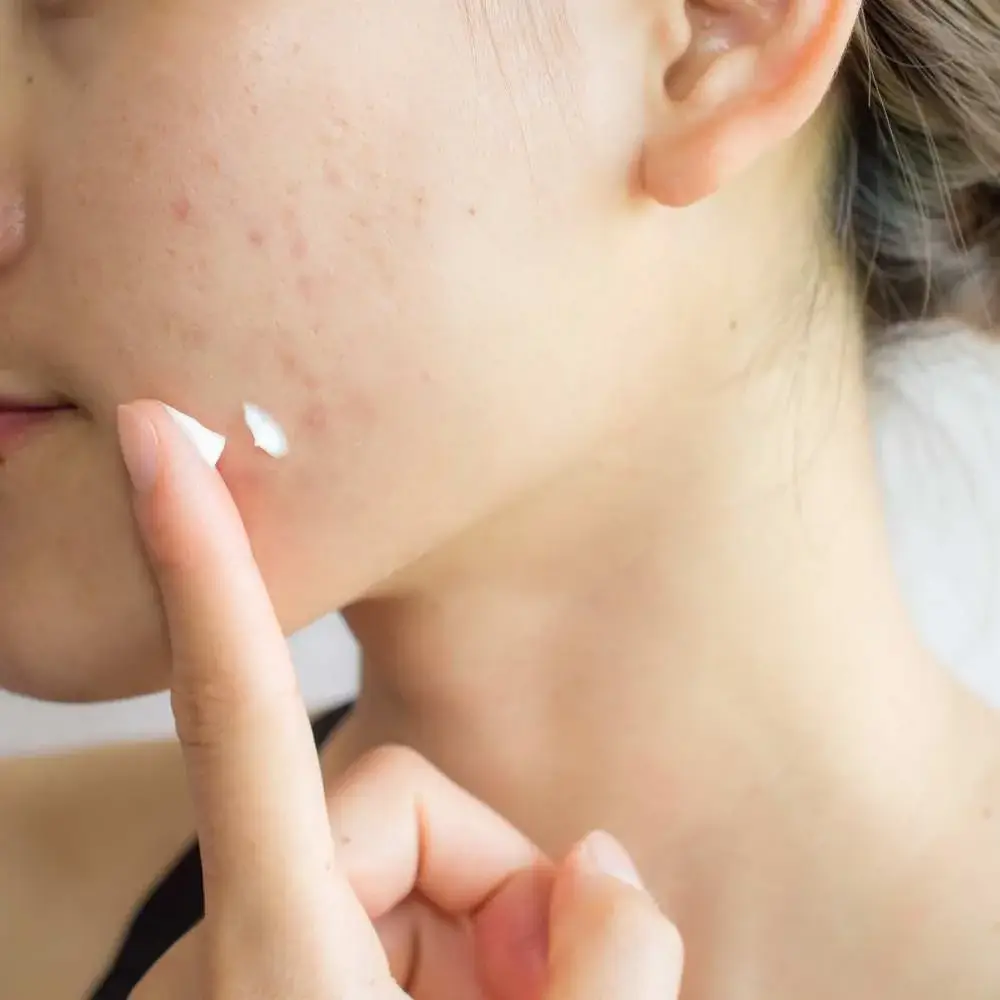 demonstrating the effect of makeup to hide acne