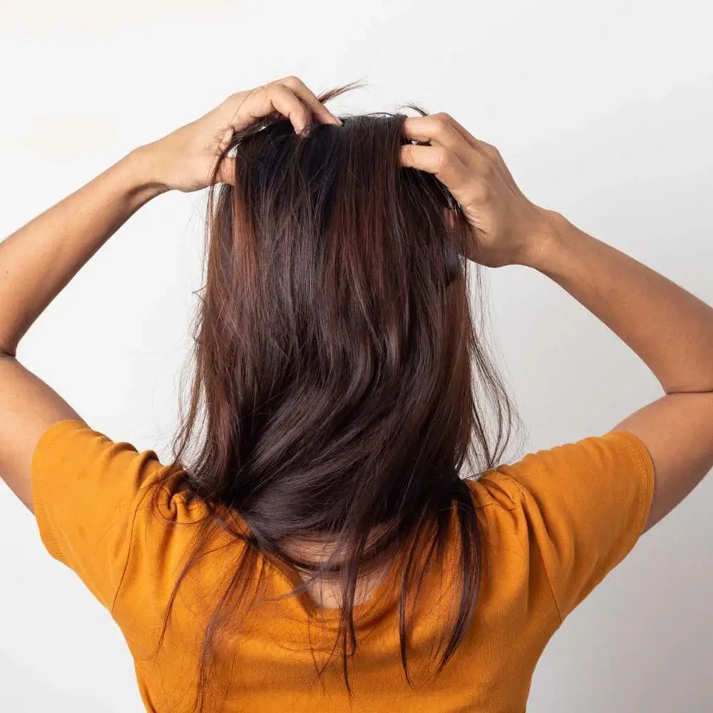 dandruff flakes, a common cause of an itchy scalp