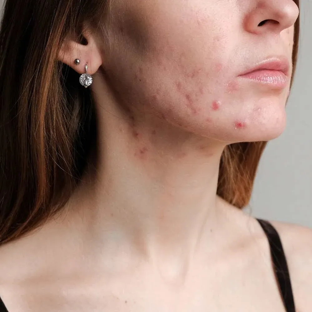 acne-prone skin