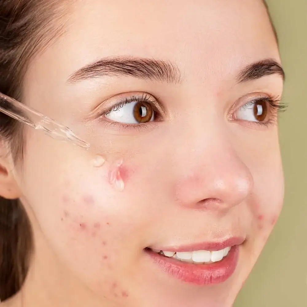 right primer can make acne-prone skin ready for flawless makeup