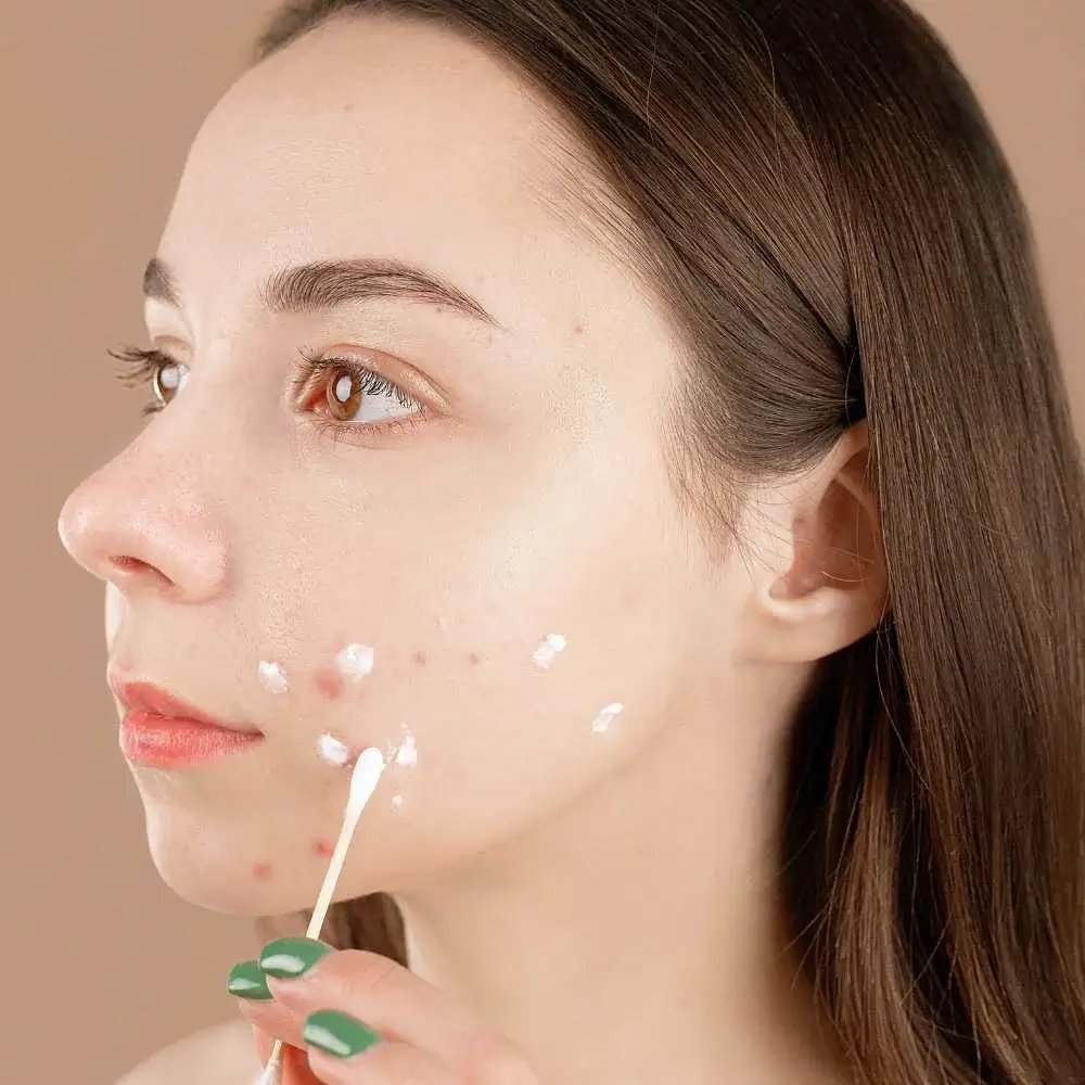 Applying acne-fighting Korean face cream