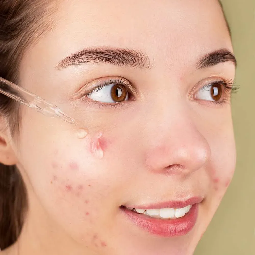 Teenager struggling with acne-prone skin