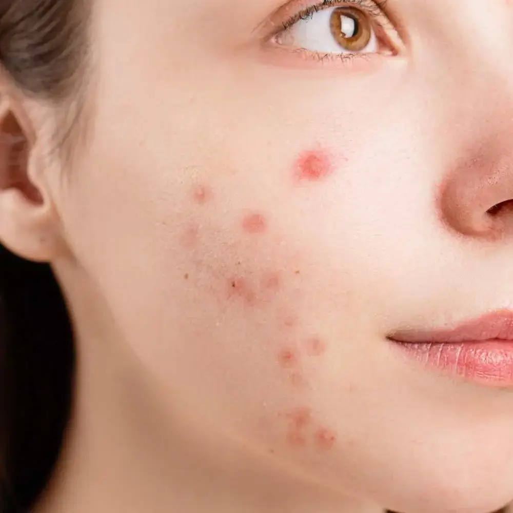 Effective acne concealer solution