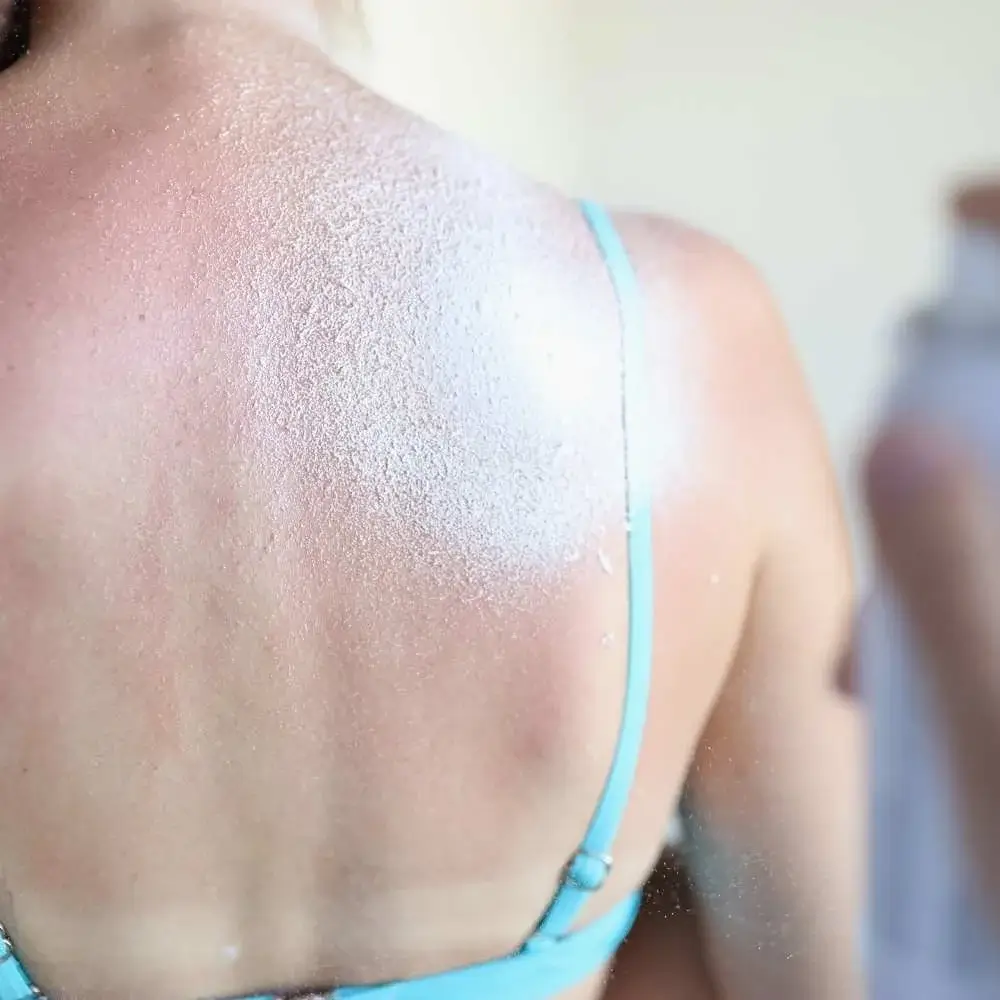 Beachgoer using sunscreen