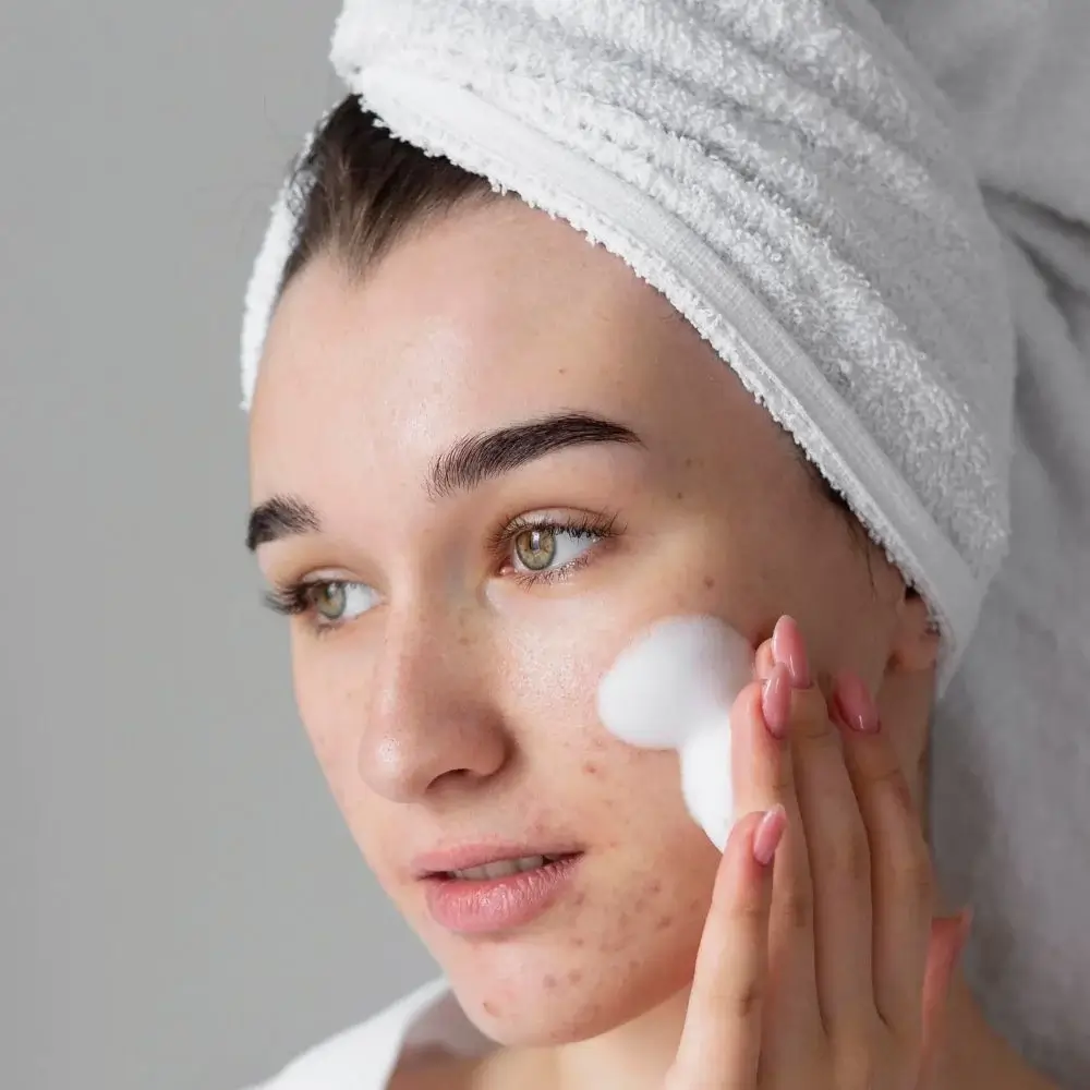 Is SPF 30 or 50 better for acne-prone skin?