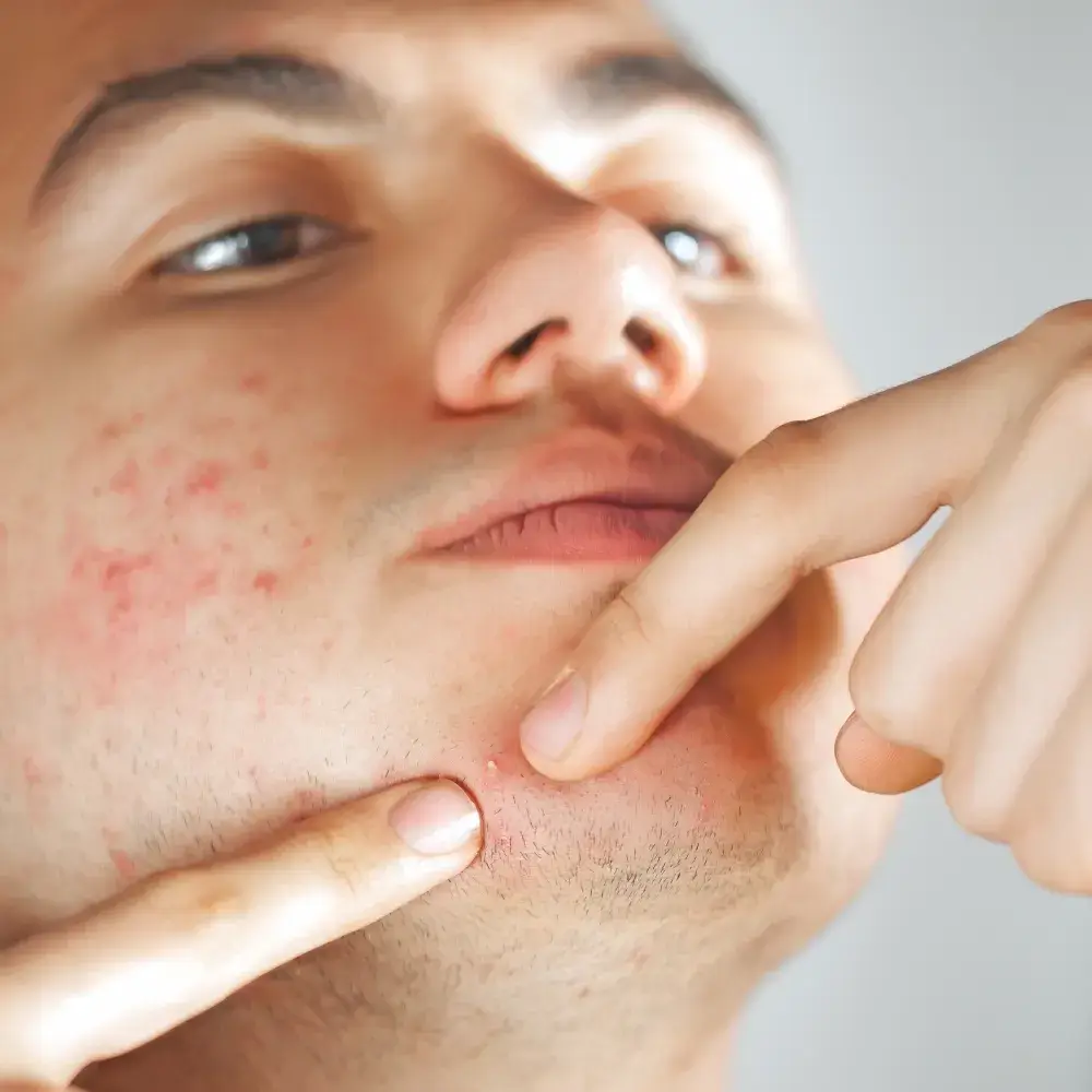 close up of a teen boy squeezing a pimple on his face