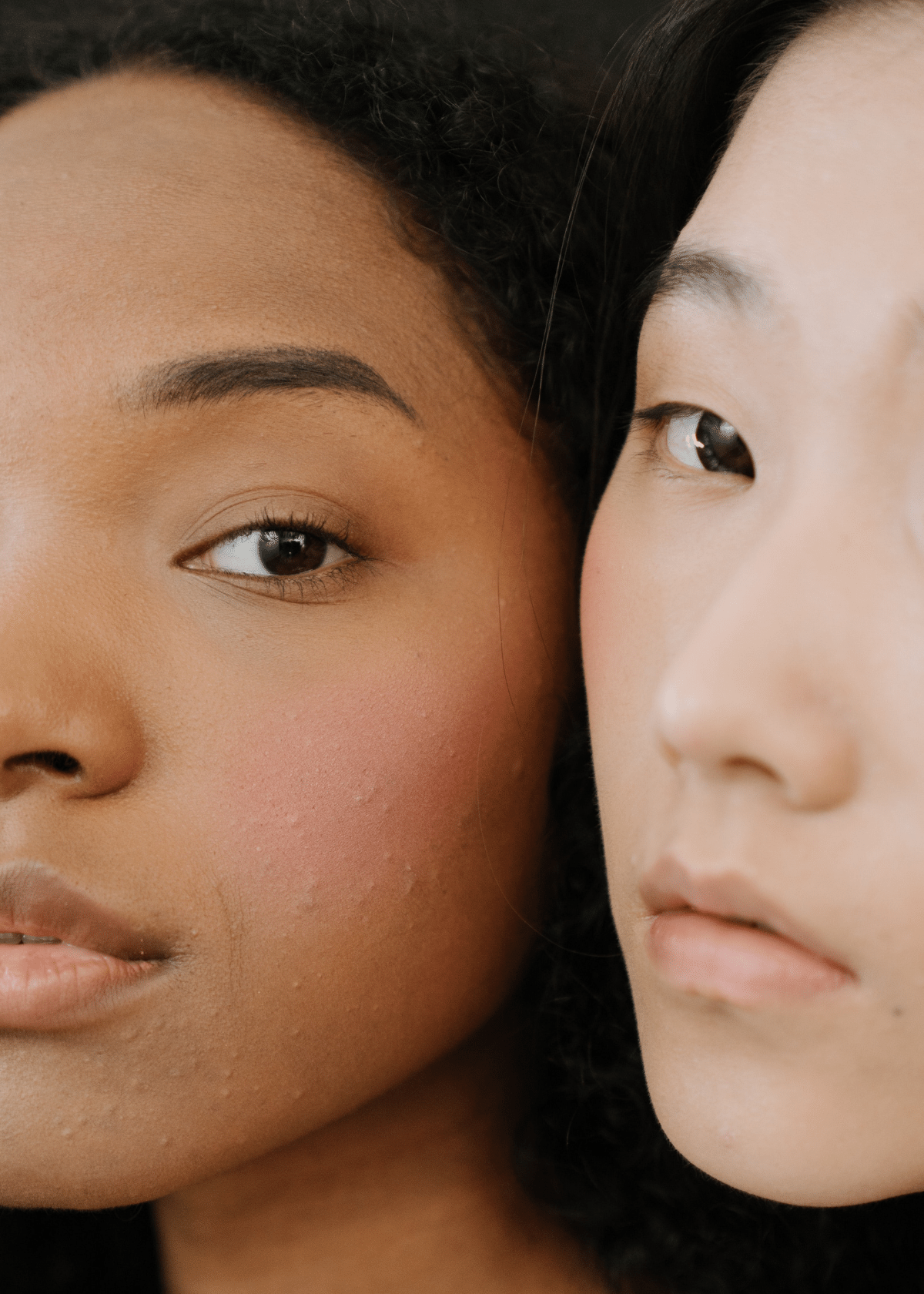 How to Choose the Best Concealer for Acne-Prone Skin