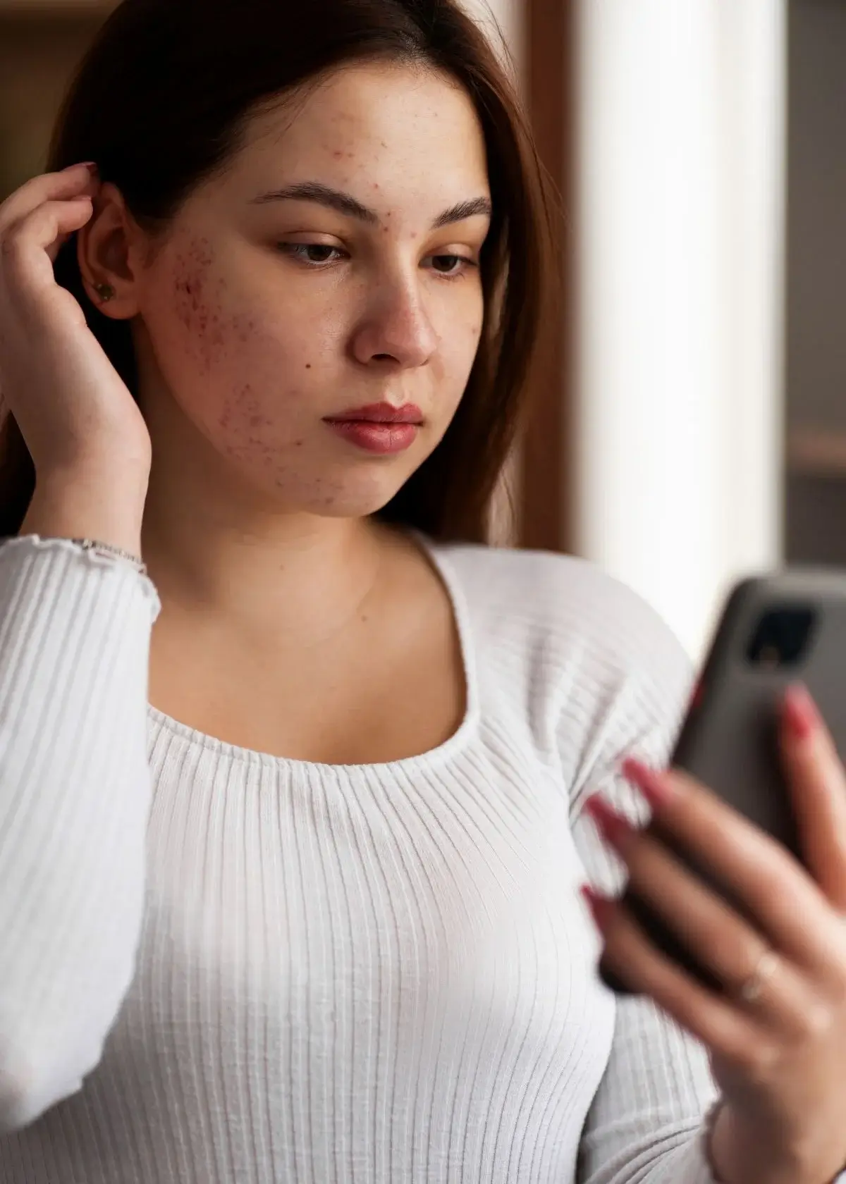 What is fungal acne and how does it differ from regular acne?