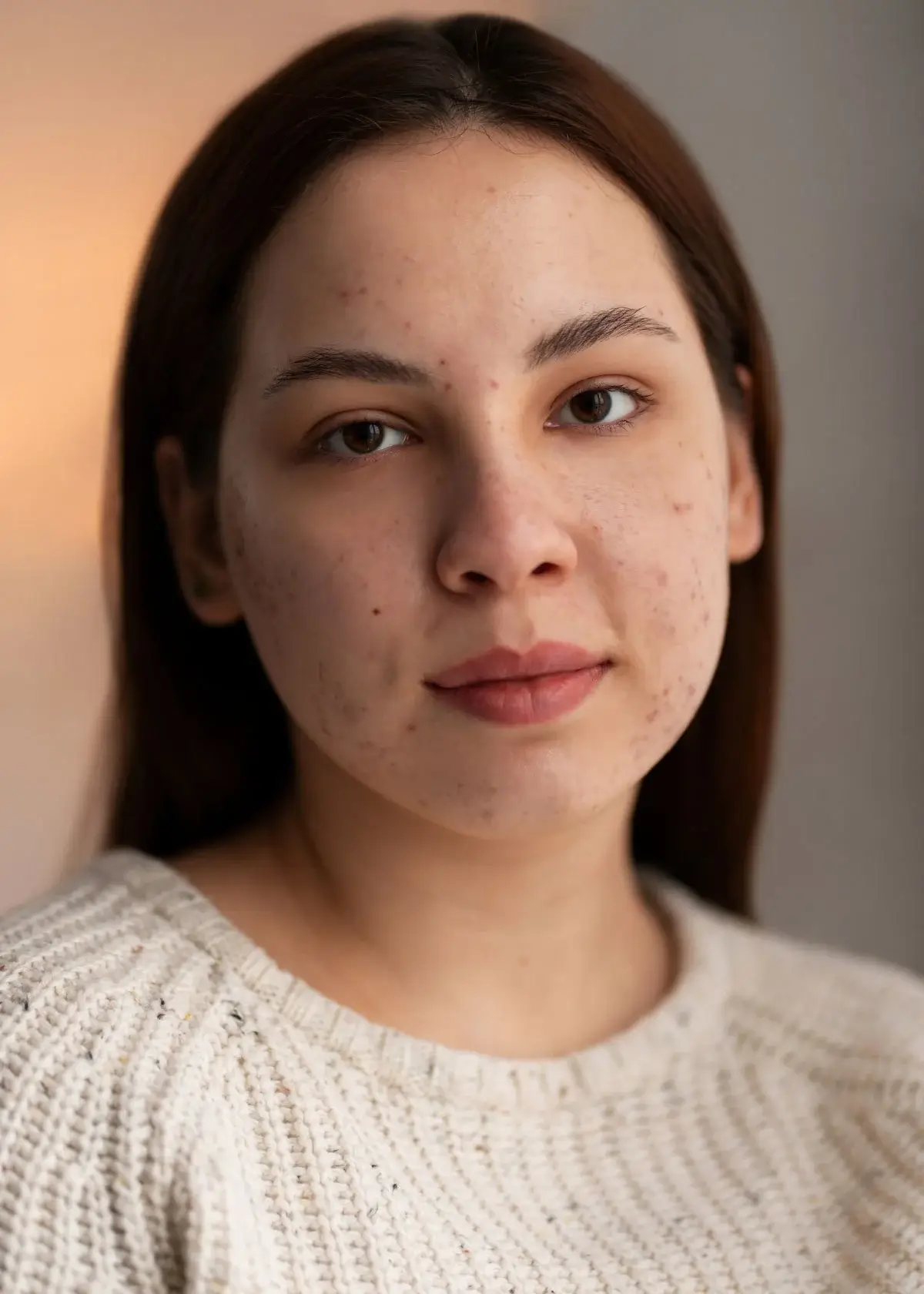 How can I choose the right shade of foundation for my acne scars?