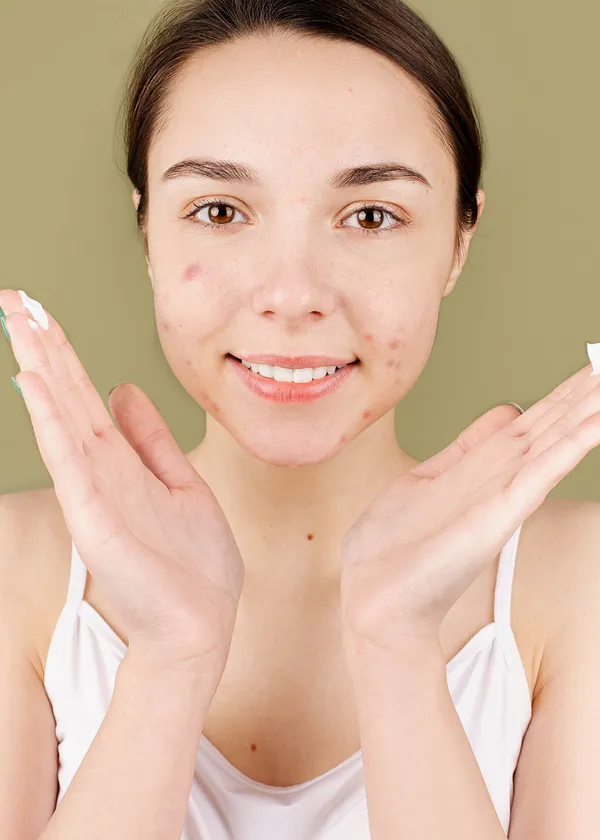 How to best hide your acne!