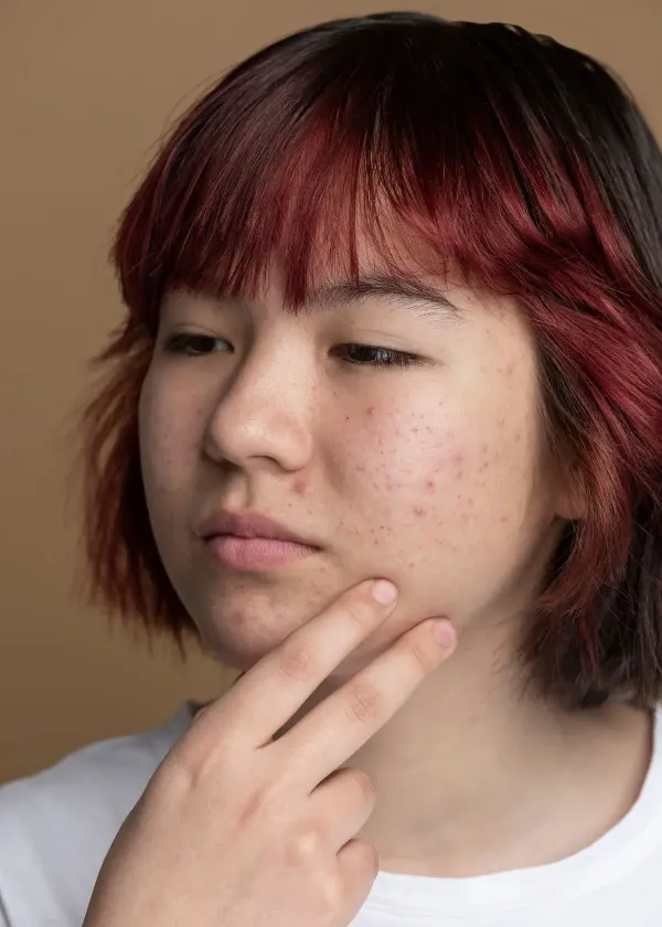Unleash Your Inner Beauty Guru: Makeup Tricks for Acne Scar Warriors!